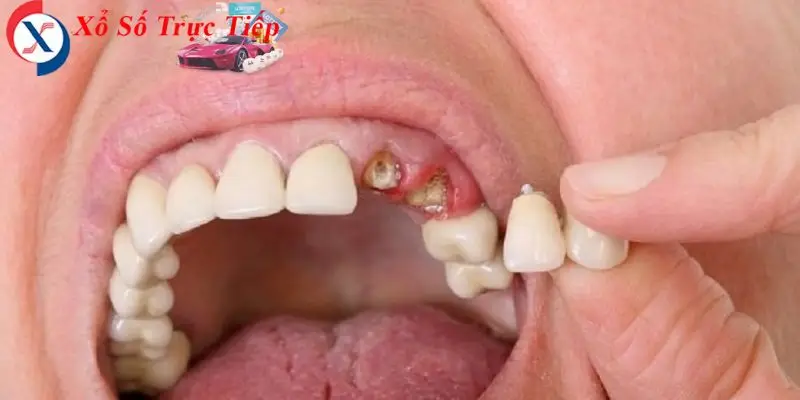 Mơ rụng răng đánh con gì là một trong những từ khóa phổ biến nhất