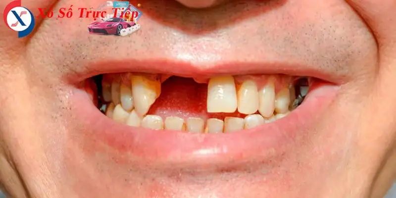 Giấc mơ về rụng răng cũng gắn liền với những con số